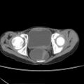 Colocolic fistula - Crohn disease (Radiopaedia 57063-63955 A 85).jpg