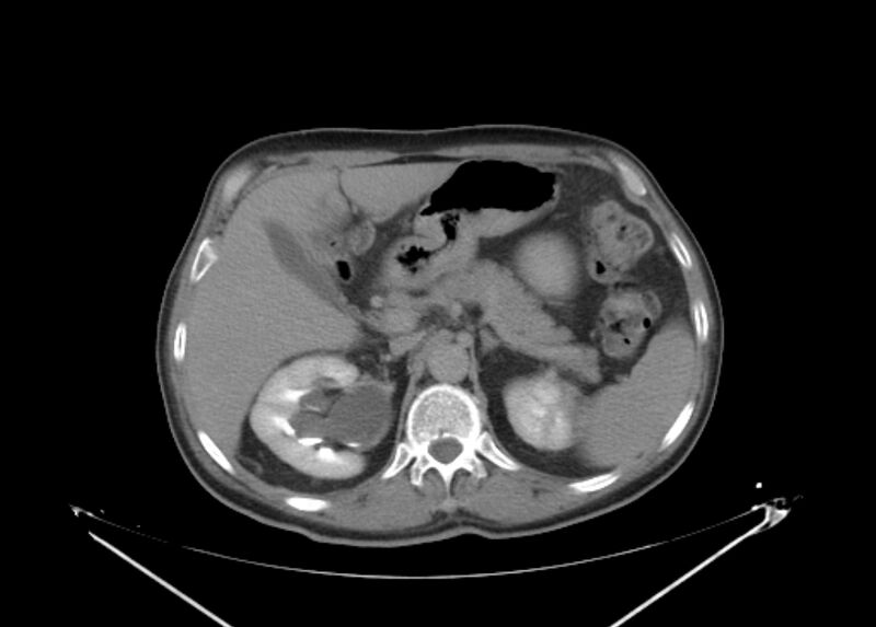File:Colon cancer mimicking renal cell carcinoma (Radiopaedia 28986-29335 Axial C+ delayed 21).jpg