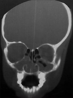 CT PNS showing the bilateral maxillary and nasal polyps