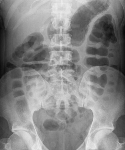 File:Crohn's disease (Radiopaedia 13155).jpg