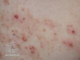 Crusted eczema