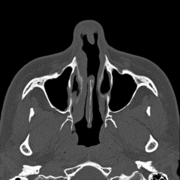 File:Nasal septal perforation (Radiopaedia 25030-25289 Axial bone window 15).jpg