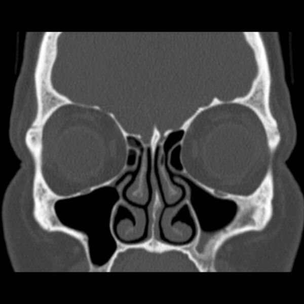 File:Nasolabial cyst (Radiopaedia 33987-35205 Coronal bone window 33).jpg