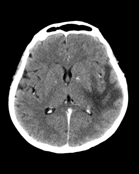 File:Nasopharyngeal carcinoma with cerebral abscess (Radiopaedia 43018-46275 Axial C+ delayed 27).png