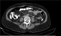 Necrotizing pancreatitis (Radiopaedia 20595-20495 Axial C+ delayed 27).jpg