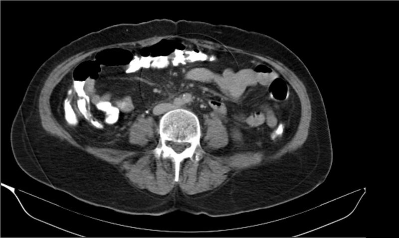 File:Necrotizing pancreatitis (Radiopaedia 20595-20495 Axial C+ delayed 27).jpg