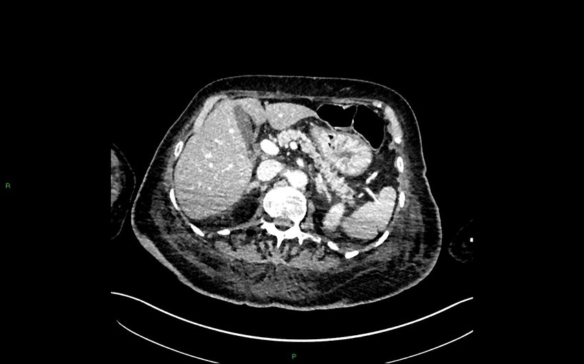 Neo-terminal ileal stricture (Crohn disease) (Radiopaedia 33790-34948 A 126).jpg