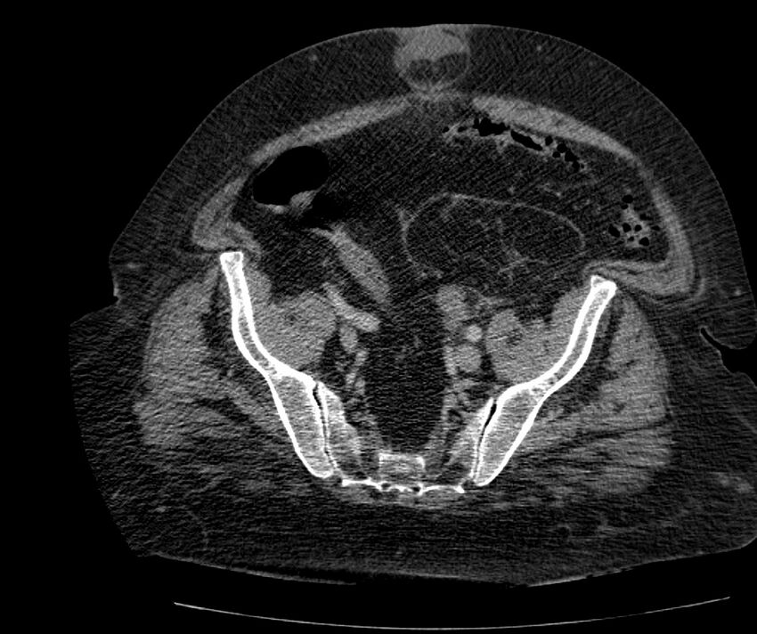 Nephroptosis with inguinal hernia containing perirenal fat (Radiopaedia 56632-63391 C 272).jpg