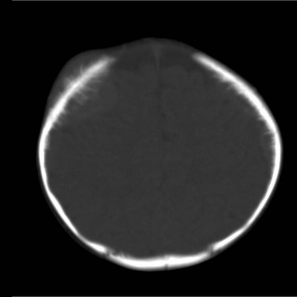 File:Neuroblastoma with skull metastases (Radiopaedia 30326-30958 Axial bone window 17).jpg