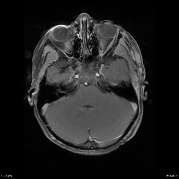 File:Neurofibromatosis type 1 (Radiopaedia 22541-22564 Axial T1 C+ fat sat 21).jpg