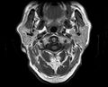 Non-Hodgkin lymphoma - parotid gland (Radiopaedia 71531-81890 Axial T1 15).jpg