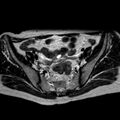 Non-puerperal uterine inversion (Radiopaedia 78343-90983 Axial T2 27).jpg