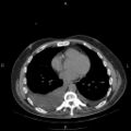 Non Hodgkin lymphoma in a patient with ankylosing spondylitis (Radiopaedia 84323-99624 Axial non-contrast 22).jpg