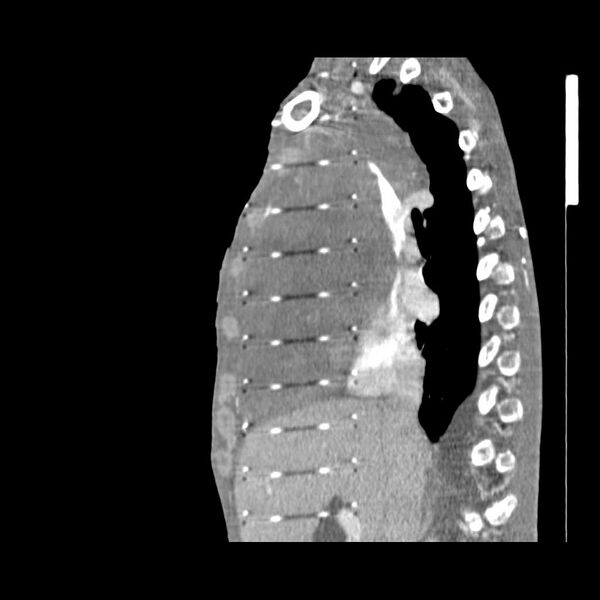 File:Non hodgkin lymphoma of the mediastinum (Radiopaedia 20814-20729 D 12).jpg