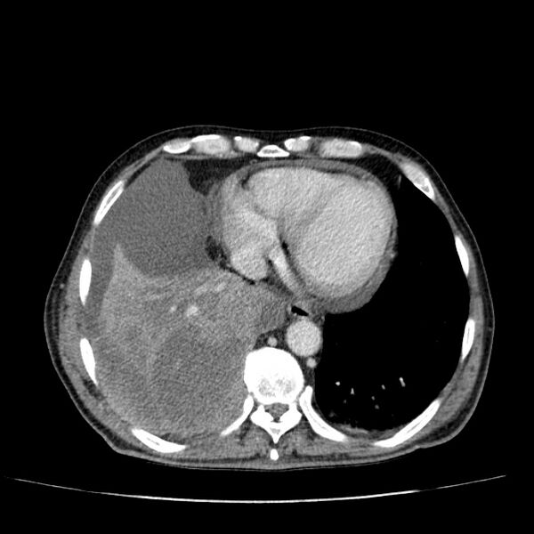 File:Non small-cell lung cancer (Radiopaedia 24467-24769 C+ delayed 46).jpg