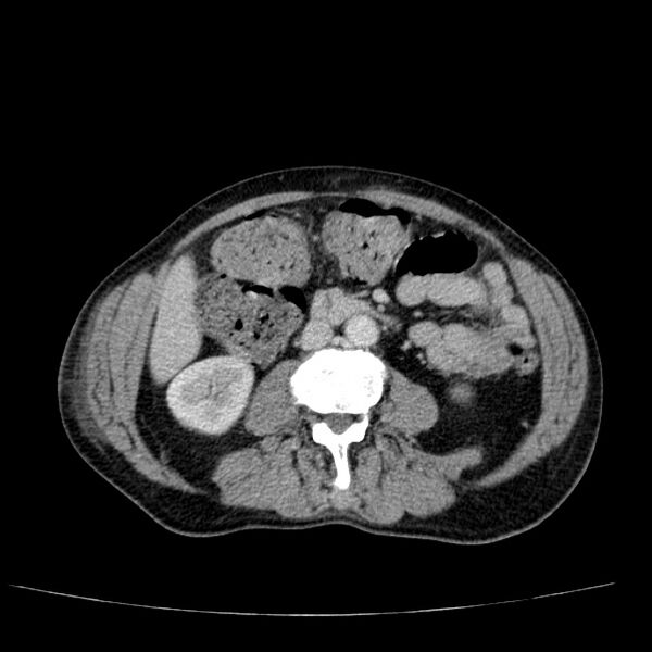 File:Non small-cell lung cancer (Radiopaedia 24467-24769 C+ delayed 80).jpg