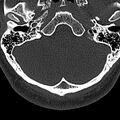 Normal CT of the cervical spine (Radiopaedia 53322-59305 Axial bone window 18).jpg