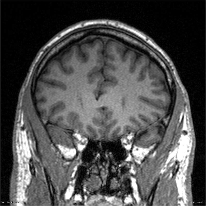 Normal brain MRI (non-focal epilepsy protocol) (Radiopaedia 38571-40700 Coronal T1 76).jpg