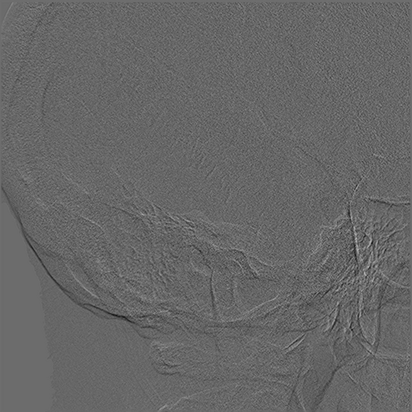 File:Normal cerebral angiogram (four vessel DSA) (Radiopaedia 41708-44649 O 5).png