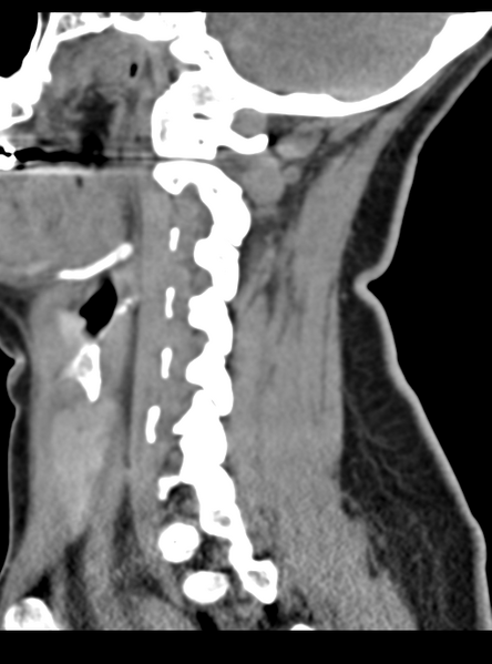 File:Normal cervical spine MRI (including Dixon) (Radiopaedia 42762-45926 C 20).png