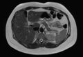 Normal liver MRI with Gadolinium (Radiopaedia 58913-66163 Axial T2 21).jpg