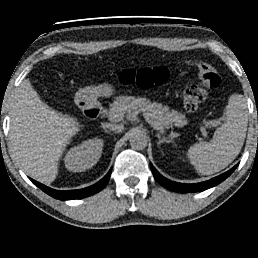 Obstructing ureteric calculus and ureteric anatomy (Radiopaedia 62730-71042 Axial non-contrast 11).jpg