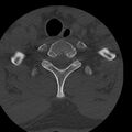 Occipital condyle fracture (Radiopaedia 31755-32691 Axial bone window 78).jpg