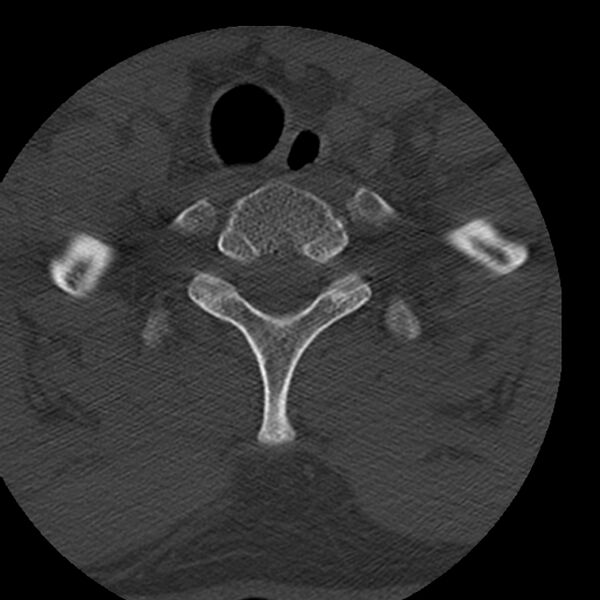 File:Occipital condyle fracture (Radiopaedia 31755-32691 Axial bone window 78).jpg