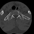 Occipital condyle fracture (Radiopaedia 31755-32691 Axial bone window 82).jpg