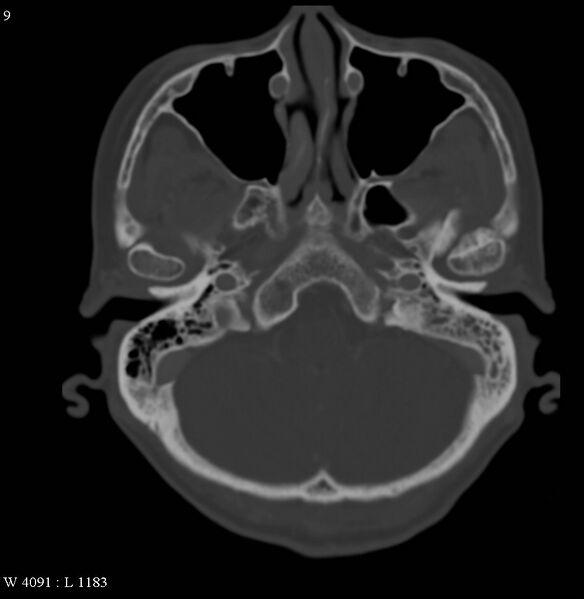 File:Occipital condyle metastasis - into mastoid (Radiopaedia 5424-7177 Axial bone window 9).jpg