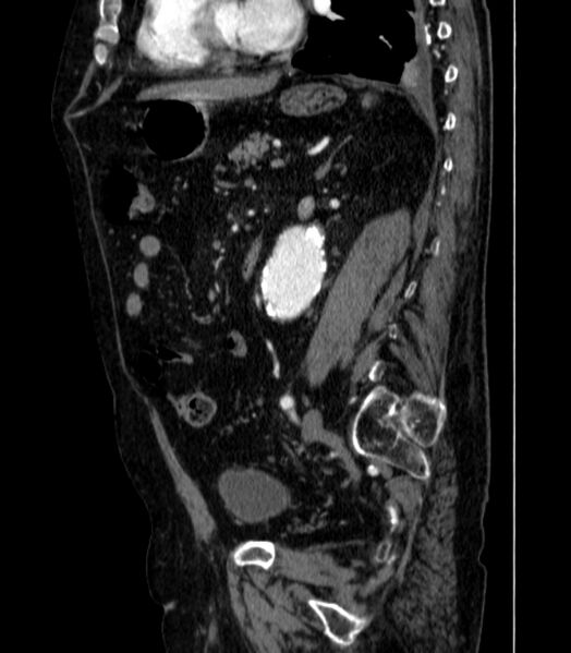 File:Abdominal aortic aneurysm (Radiopaedia 25855-26001 Sagittal C+ arterial phase 41).jpg