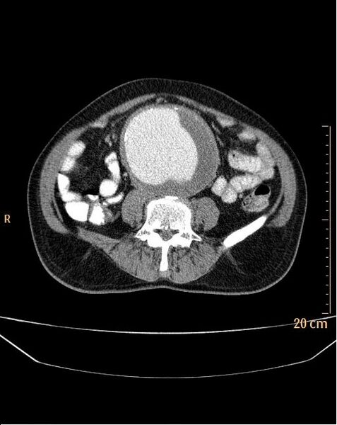File:Abdominal aortic aneurysm (Radiopaedia 25985-26121 Axial C+ arterial phase 22).jpg