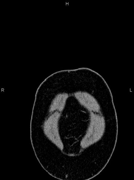 File:Abdominal aortic aneurysm (Radiopaedia 83094-97462 Coronal renal cortical phase 3).jpg