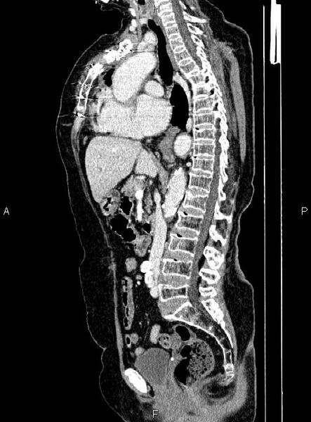 File:Abdominal aortic aneurysm (Radiopaedia 85063-100606 Sagittal C+ arterial phase 40).jpg
