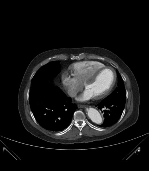 File:Abdominal aortic aneurysm with thrombus fissuration (Radiopaedia 46218-50618 Axial C+ arterial phase 1).jpg