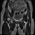 Abdominal wall endometriosis (Radiopaedia 83702-98847 Coronal T2 5).jpg