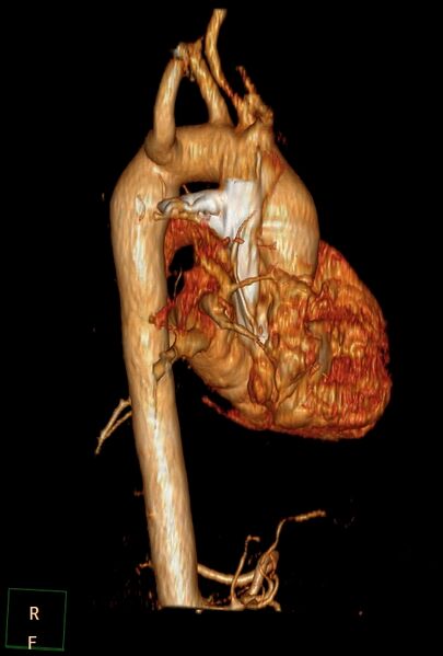 File:Aberrant right subclavian artery (Radiopaedia 67135-76475 B 20).jpg