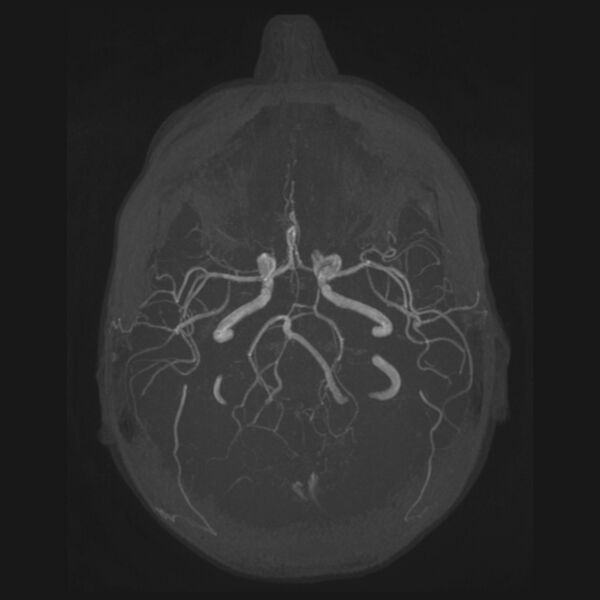 File:Accessory middle cerebral artery and ICA aneurysm (Radiopaedia 22656-22674 B 18).jpg