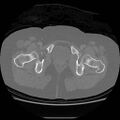 Acetabular fracture (Radiopaedia 13193-13212 Axial bone window 43).jpg