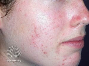 Acne-face 38 (DermNet NZ acne-acne-face-acne-face-38).jpg
