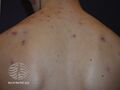 Acne affecting the back images (DermNet NZ acne-acne-back-148).jpg