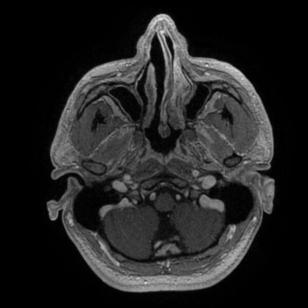 File:Acoustic schwannoma - intracanalicular (Radiopaedia 37247-39024 Axial T1 C+ 37).jpg