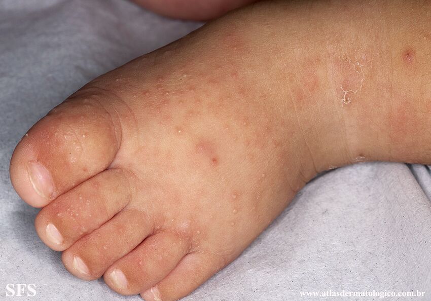 Acropustulosis Infantile (Dermatology Atlas 16).jpg