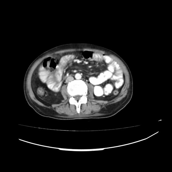 File:Acute-on-chronic Crohn disease with enteroenteric fistula (Radiopaedia 66686-75987 B 1).jpg