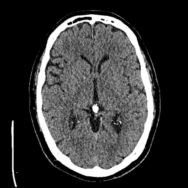File:Acute A3 occlusion with ACA ischemic penumbra (CT perfusion) (Radiopaedia 72036-82525 Axial non-contrast thins 29).jpg