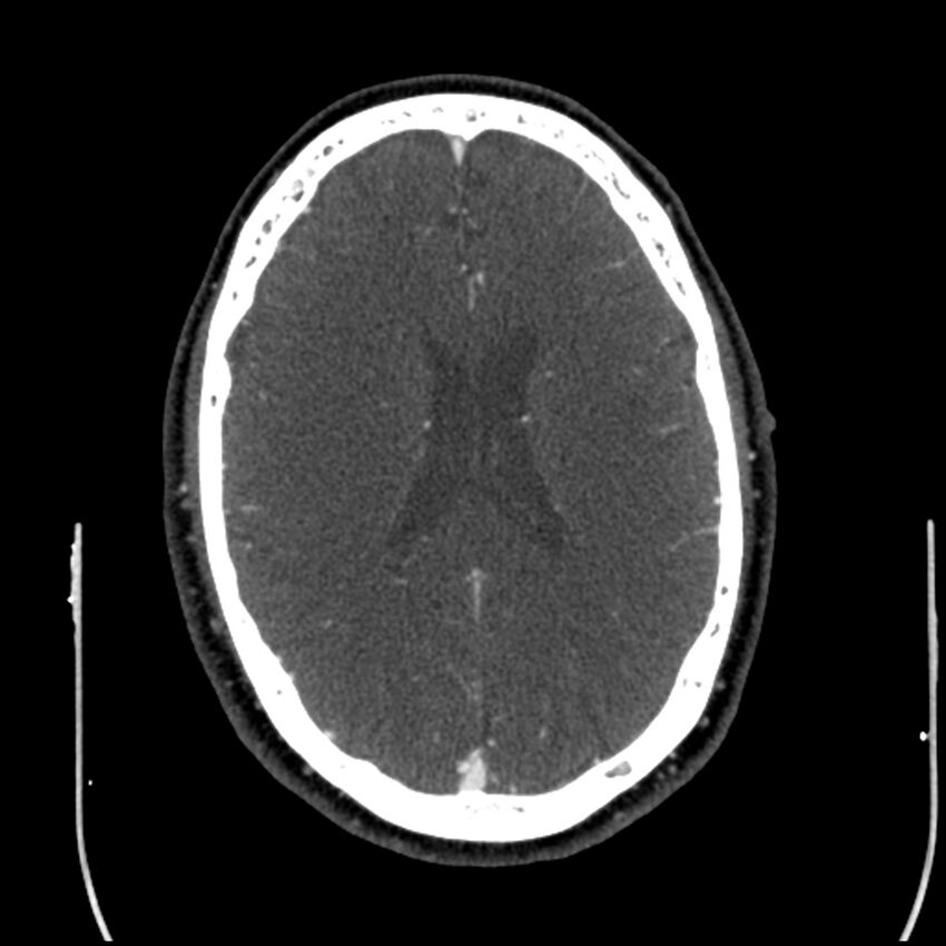 Acute A3 occlusion with ACA ischemic penumbra (CT perfusion) (Radiopaedia 72036-82527 Axial C+ arterial phase thins 38).jpg