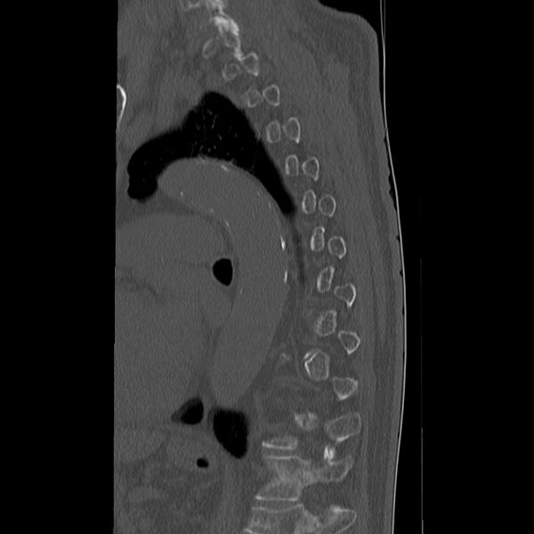 File:Acute and chronic vertebral compression fractures (Radiopaedia 31608-32494 Sagittal bone window 25).jpg