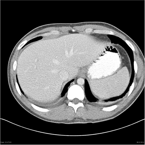 File:Acute appendicitis (Radiopaedia 25364-25615 B 4).jpg
