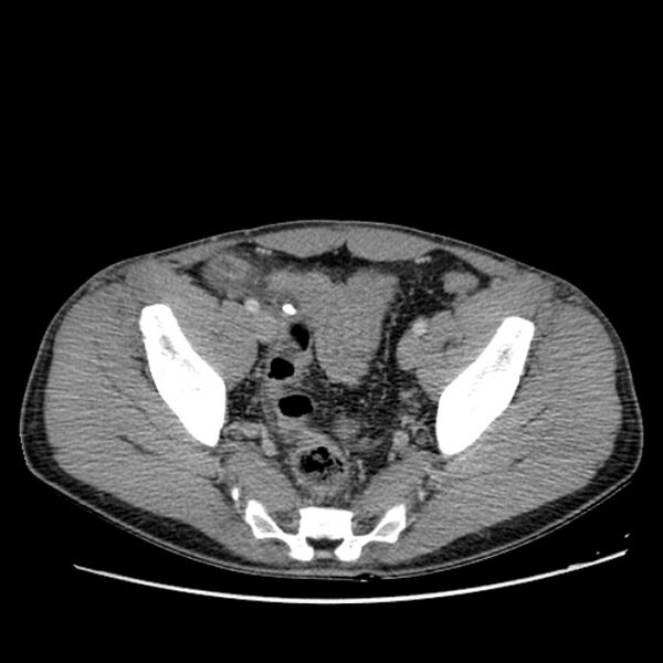 File:Acute appendicitis (Radiopaedia 27049-27227 Axial C+ portal venous phase 63).jpg