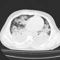 Acute aspiration pneumonitis (Radiopaedia 33605-34703 Axial lung window 59).jpg